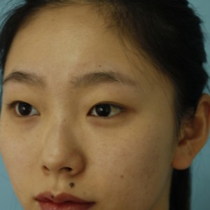 鄭州安格潤整形醫(yī)生楊曉紅做雙眼皮手術(shù)怎么樣？附案例效果圖