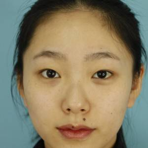 鄭州安格潤(rùn)整形醫(yī)生楊曉紅做雙眼皮手術(shù)怎么樣？附案例效果圖