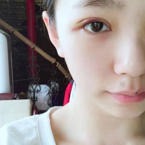 鄭州安格潤整形醫(yī)生楊曉紅做雙眼皮手術(shù)怎么樣？附案例效果圖