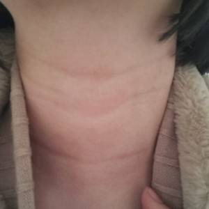 昭通愛(ài)麗諾整形醫(yī)生陳志江做嗨體去頸紋怎么樣？附案例效果圖