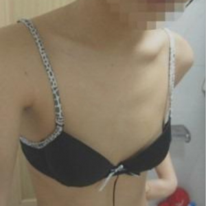 三亞圣迪亞整形美容醫(yī)院醫(yī)生韓超做假體隆胸怎么樣？附案例效果對比圖