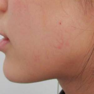 蚌埠韓美美萊整形醫(yī)院醫(yī)生張濤做玻尿酸墊下巴怎么樣？來看案例效果圖