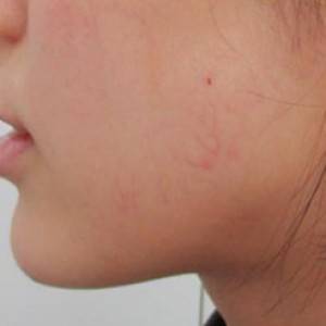 蚌埠韓美美萊整形醫(yī)院醫(yī)生張濤做玻尿酸墊下巴怎么樣？來看案例效果圖
