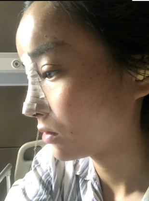 武漢米蘭醫(yī)療美容醫(yī)生柳再億做眼綜合+鼻綜合整形怎么樣？附真實(shí)案例對(duì)比圖