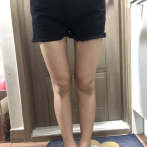 貴陽華美整形美容醫(yī)院醫(yī)生田永華做大腿吸脂效果怎么樣？附大腿吸脂案例前后對比圖