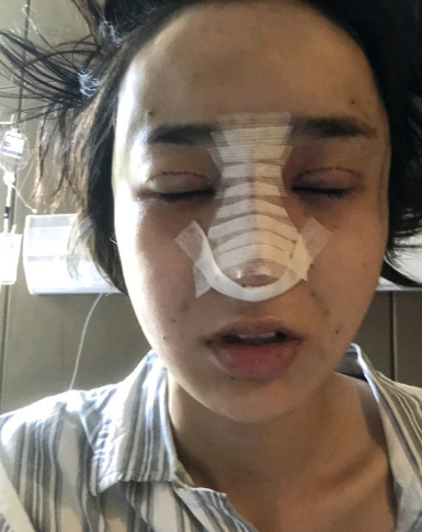 武漢米蘭醫(yī)療美容醫(yī)生柳再億做眼綜合+鼻綜合整形怎么樣？附真實(shí)案例對(duì)比圖