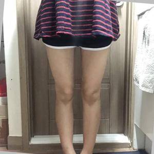 貴陽(yáng)華美整形美容醫(yī)院醫(yī)生田永華做大腿吸脂效果怎么樣？附大腿吸脂案例前后對(duì)比圖