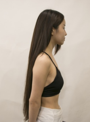 吉林現(xiàn)代整形美容醫(yī)院做假體隆胸效果怎么樣？附醫(yī)院案例效果對比圖