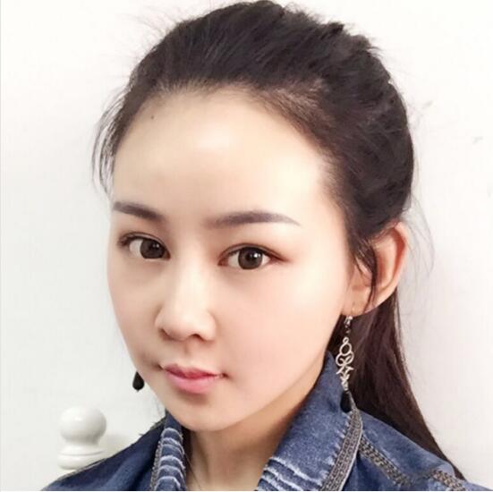 上海時光整形外科醫(yī)院醫(yī)生李靜林做假體隆鼻和反頜手術(shù)怎么樣？