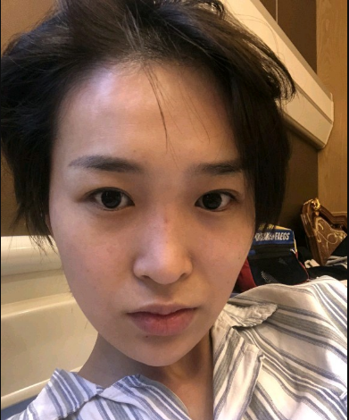武漢米蘭醫(yī)療美容醫(yī)生柳再億做眼綜合+鼻綜合整形怎么樣？附真實(shí)案例對比圖