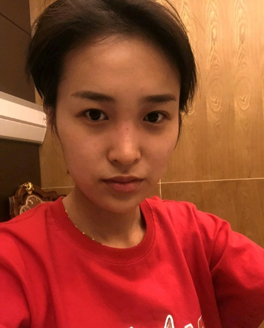 武漢米蘭醫(yī)療美容醫(yī)生柳再億做眼綜合+鼻綜合整形怎么樣？附真實(shí)案例對(duì)比圖