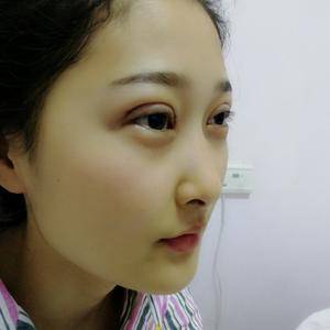 周口垣夢醫(yī)療整形醫(yī)生王濤做切開雙眼皮怎么樣？附切開雙眼皮案例效果對比圖