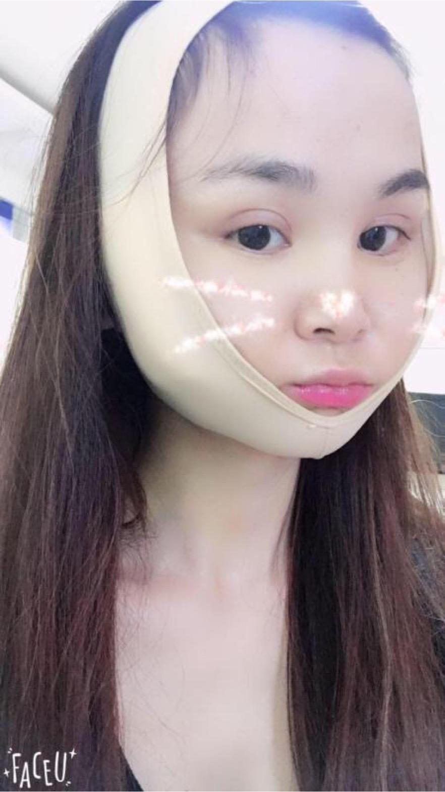 北京彤美美容整形醫(yī)院醫(yī)生楊曉惠做顴骨內(nèi)推+面部吸脂手術(shù)效果怎么樣？附案例