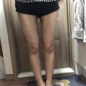貴陽(yáng)華美整形美容醫(yī)院醫(yī)生田永華做大腿吸脂效果怎么樣？附大腿吸脂案例前后對(duì)比圖