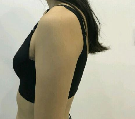 武漢伽美醫(yī)療美容醫(yī)院醫(yī)生朱富初做自體脂肪隆胸怎么樣？看案例