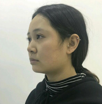 上海時光整形醫(yī)院做豐下巴怎么樣？許黎平醫(yī)生豐下巴案例分享