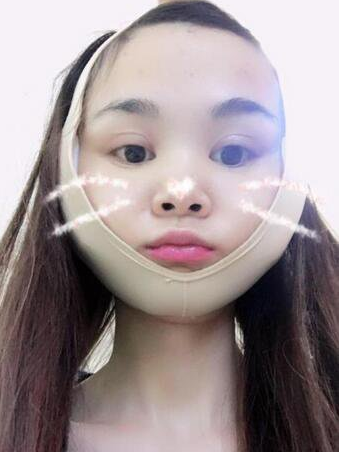 上海時光整形醫(yī)生何晉龍做下頜角磨骨術前術后案例效果對比圖
