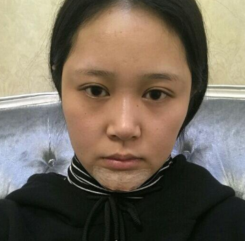 上海時光整形醫(yī)院做豐下巴怎么樣？許黎平醫(yī)生豐下巴案例分享