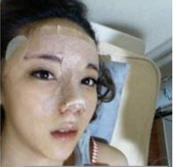 上海時(shí)光整形醫(yī)生何晉龍做假體隆鼻效果怎么樣？附案例效果對比圖