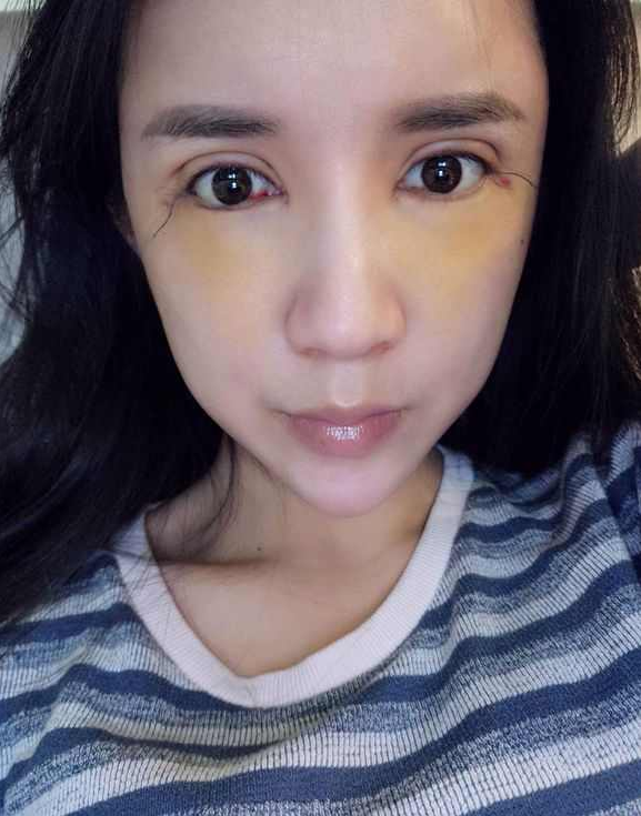 上海時光整形醫(yī)院張晶醫(yī)生做開眼角怎么樣？附真實效果圖
