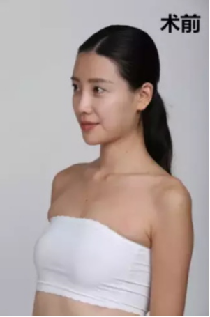 上海時光整形醫(yī)院何晉龍醫(yī)生做假體隆胸怎么樣？附案例對比圖