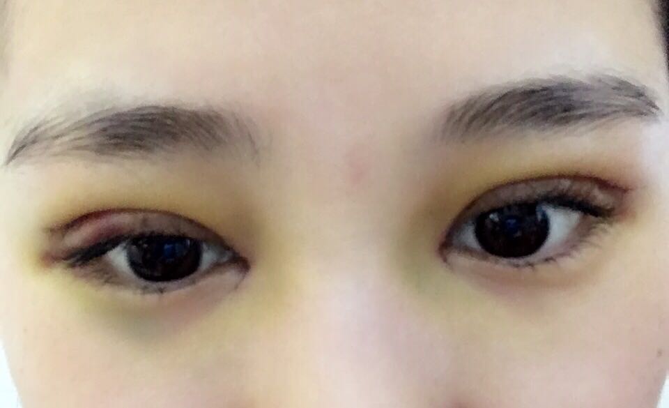 蚌埠韓美美萊整形醫(yī)生鄭捷做開(kāi)眼角怎么樣？附案例效果圖