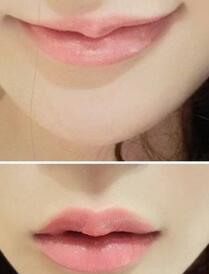 巴中時光醫(yī)學(xué)美容門診部做玻尿酸豐唇效果怎么樣？附李紅強豐唇案例