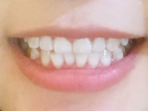 安慶渡江口腔醫(yī)院張良斌醫(yī)生做超聲波洗牙效果怎么樣？附洗牙案例效果圖