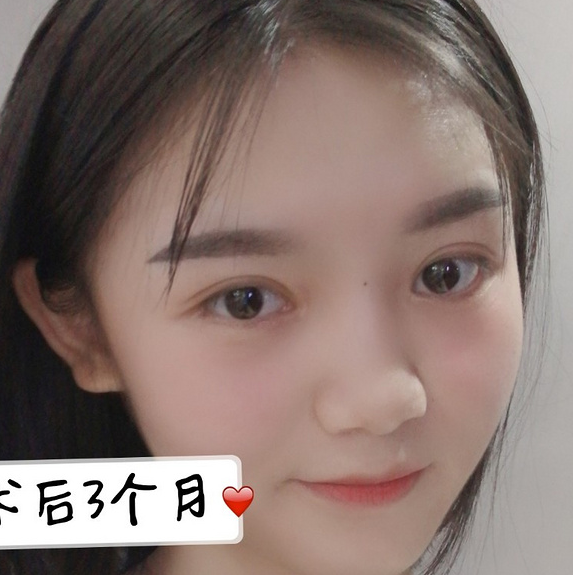 鞍山菲之都醫(yī)療整形醫(yī)院做開眼角+全切雙眼皮效果怎么樣？附藺嬌婷醫(yī)生案例