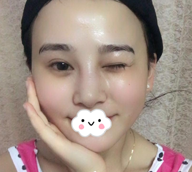 蚌埠韓美美萊整形醫(yī)生歷芳做耳軟骨隆鼻怎么樣？附耳軟骨隆鼻案例對比圖
