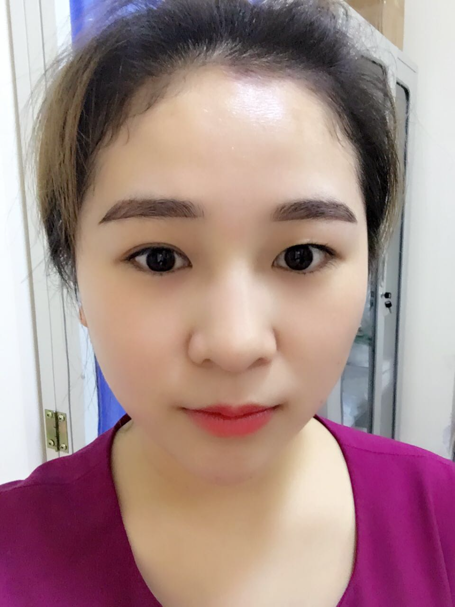 蚌埠韓美美萊整形醫(yī)生鄭捷做開眼角怎么樣？附案例效果圖