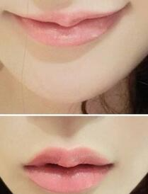 巴中時光醫(yī)學美容門診部做玻尿酸豐唇效果怎么樣？附李紅強豐唇案例