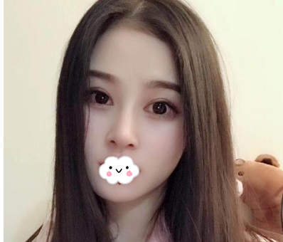 蚌埠韓美美萊整形醫(yī)生歷芳做耳軟骨隆鼻怎么樣？附耳軟骨隆鼻案例對比圖