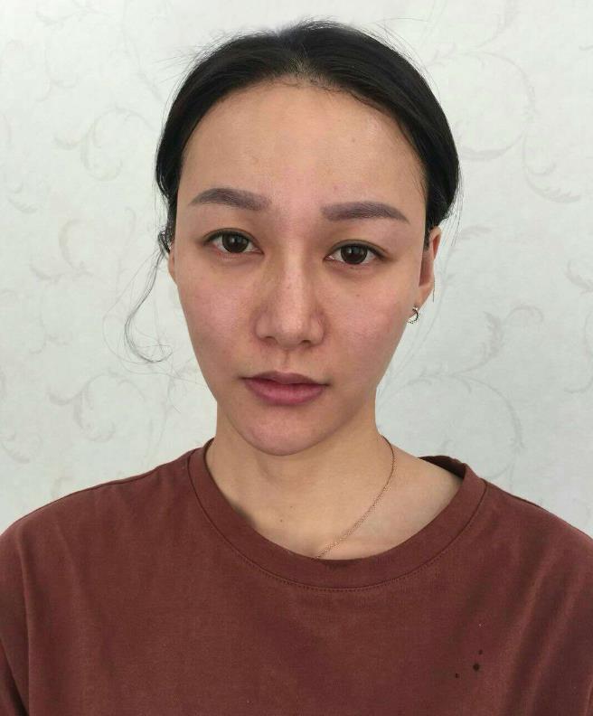 鞍山王景醫(yī)療美容外科診所做光子嫩膚怎么樣？附王景醫(yī)生案例效果圖