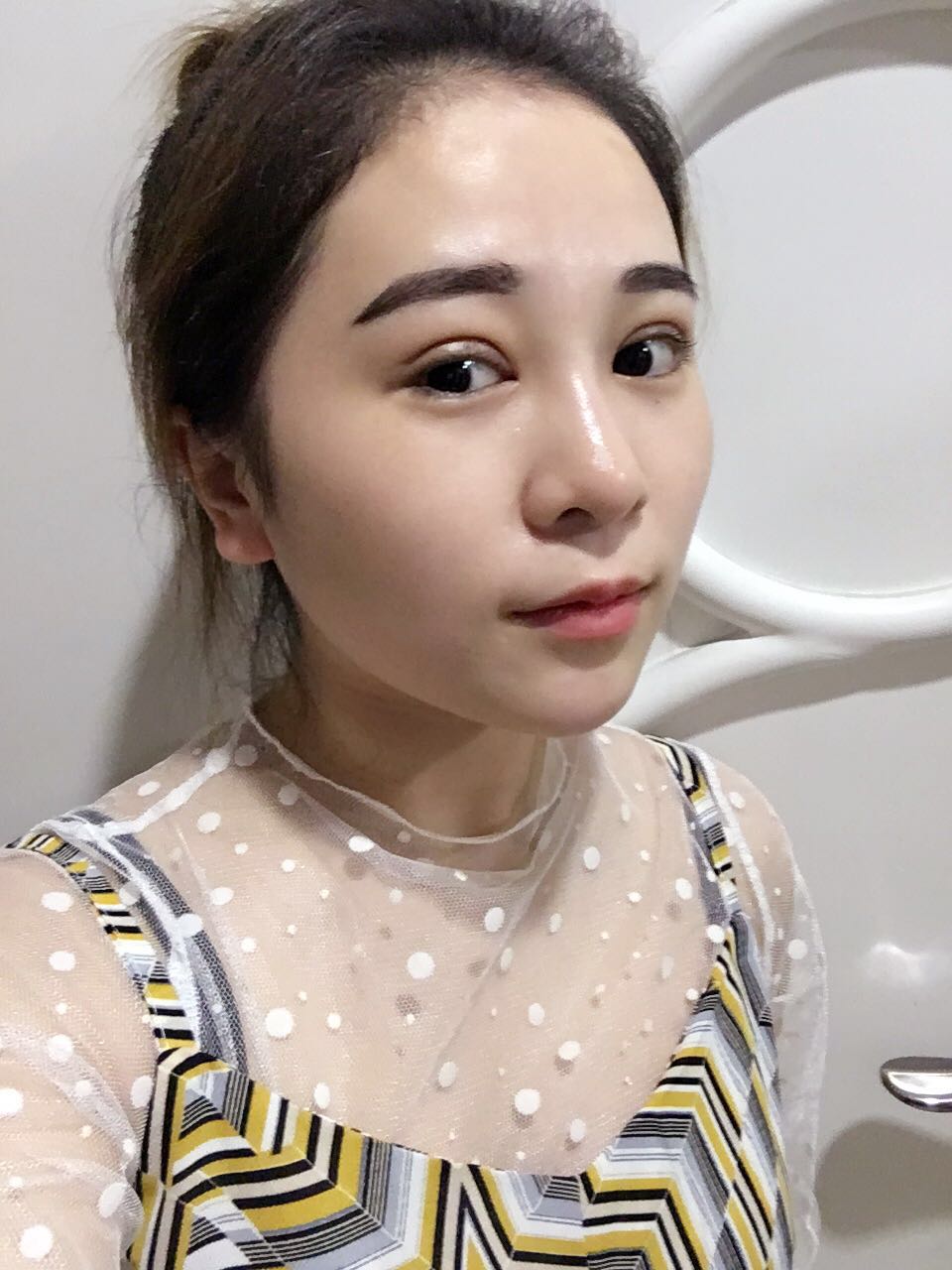 蚌埠韓美美萊整形醫(yī)生鄭捷做開(kāi)眼角怎么樣？附案例效果圖