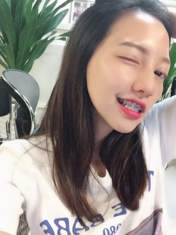 巴中華醫(yī)口腔醫(yī)院做牙齒矯正效果好嗎？附母汶靈醫(yī)生牙齒矯正案例效果圖