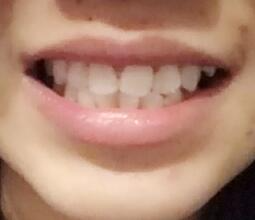 鞍山時(shí)代口腔門診部劉昕醫(yī)生做美容冠效果怎么樣？一起來看看吧