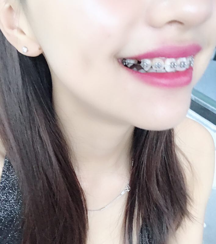 巴中華醫(yī)口腔醫(yī)院做牙齒矯正效果好嗎？附母汶靈醫(yī)生牙齒矯正案例效果圖