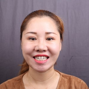保定東陽(yáng)口腔醫(yī)院趙晨醫(yī)生做瓷貼面怎么樣？附瓷貼面案例效果對(duì)比圖