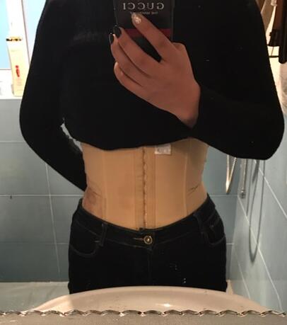 保定現(xiàn)代女子醫(yī)院整形美容中心做腰腹部吸脂怎么樣？附林秀蓮醫(yī)生案例效果圖