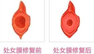 蚌埠市第三人民醫(yī)院燒傷整形科許瑾醫(yī)生做處女摸修復(fù)怎么樣？附案例