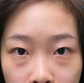 保定安卓貝拉醫(yī)療美容門診部孫大山醫(yī)生做雙眼皮+去眼袋怎么樣？附案例效果對比圖