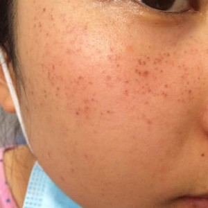 寶雞皮膚病醫(yī)院文東亮醫(yī)生做臉部祛斑效果怎么樣？附臉部祛斑案例