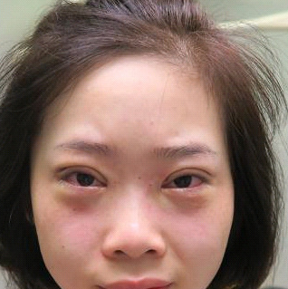 保定安卓貝拉醫(yī)療美容門診部孫大山醫(yī)生做雙眼皮+去眼袋怎么樣？附案例效果對比圖