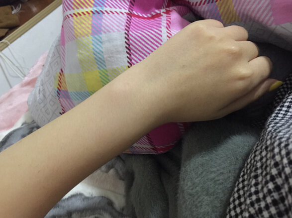 蚌埠市第三人民醫(yī)院燒傷整形科李方奇注射美白針效果怎么樣？安全嗎？附案例
