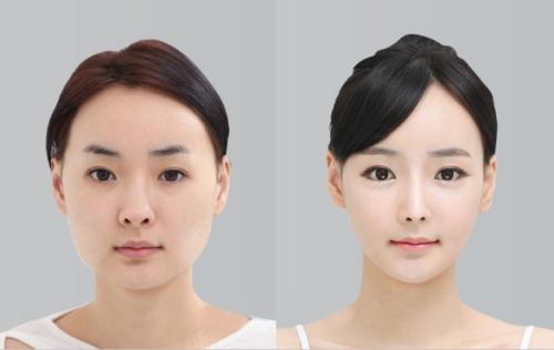 想做歐式雙眼皮，什么是歐式雙眼皮？