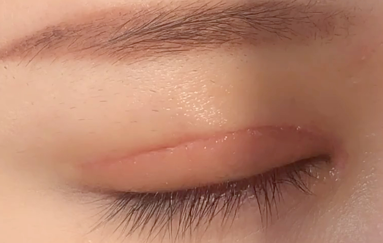 全切雙眼皮多久恢復(fù)？全切開雙眼皮有哪些優(yōu)點？