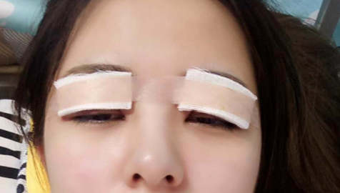 全切雙眼皮怎么恢復(fù)快？
