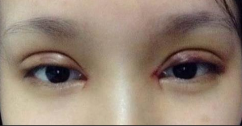 全切雙眼皮一般多久才能消腫？全切雙眼皮術(shù)后如何護理？