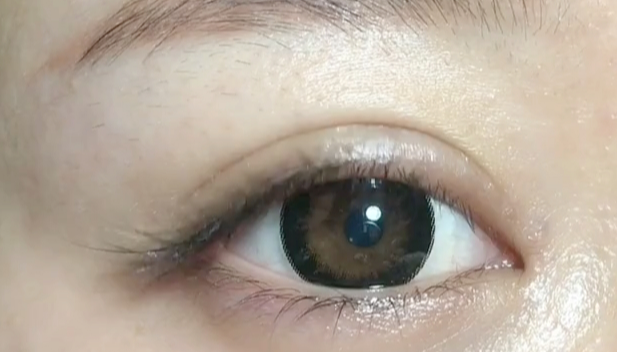 全切雙眼皮失敗可以修復(fù)嗎？